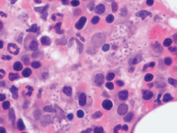 Image: Bone marrow section showing Leishmania within macrophages (Photo courtesy of University of Thessaly).